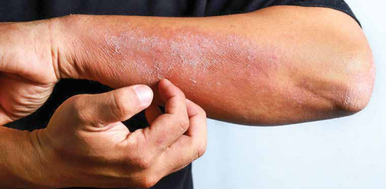 prevent-and-treat-common-spring-rashes-metro-news